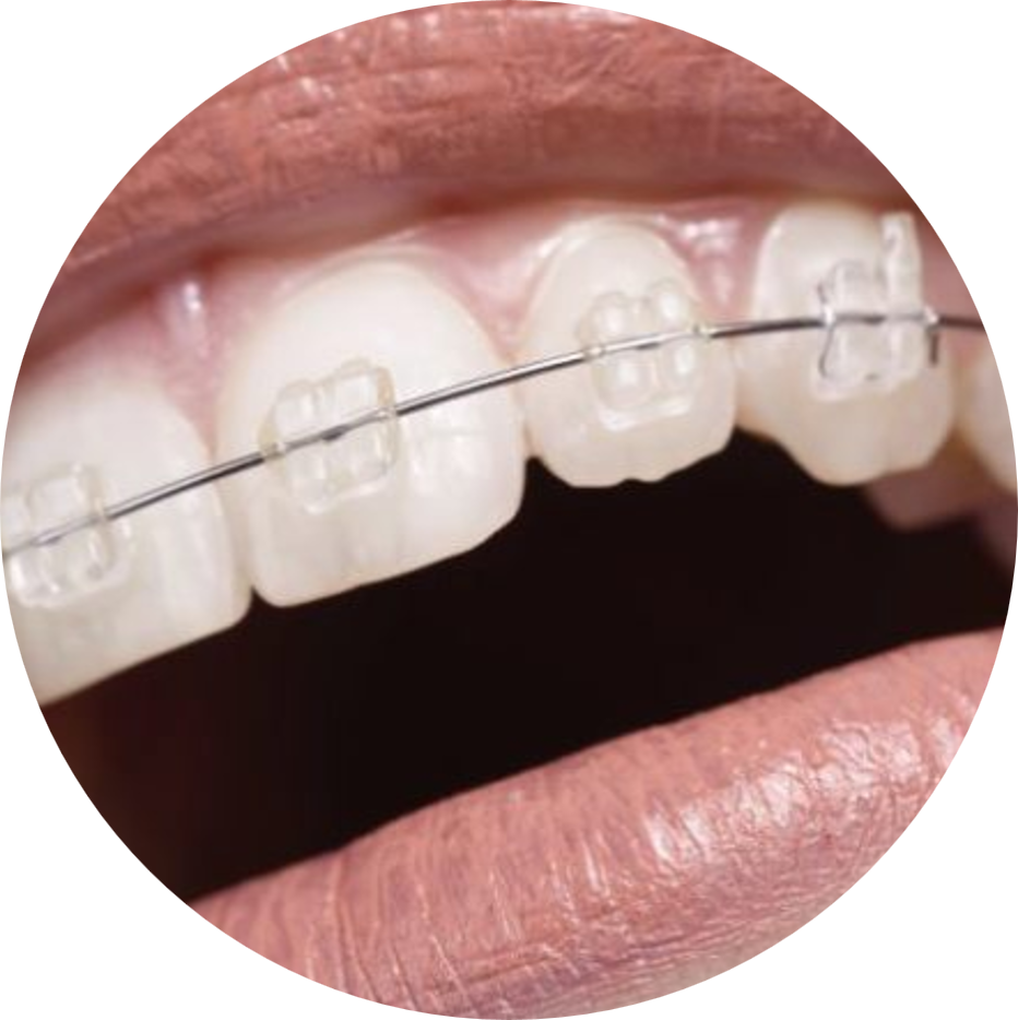 Ceramic Braces