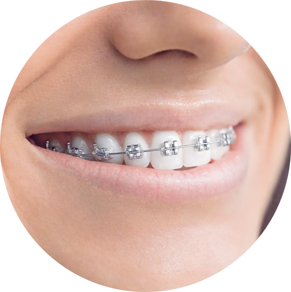Metal Braces