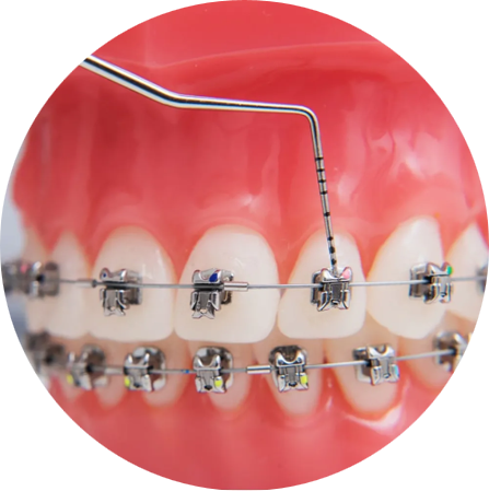 Self-ligating Braces
